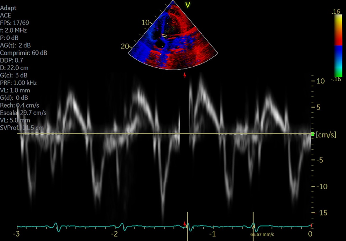 Figura 4. Doppler tisular del anillo mitral.