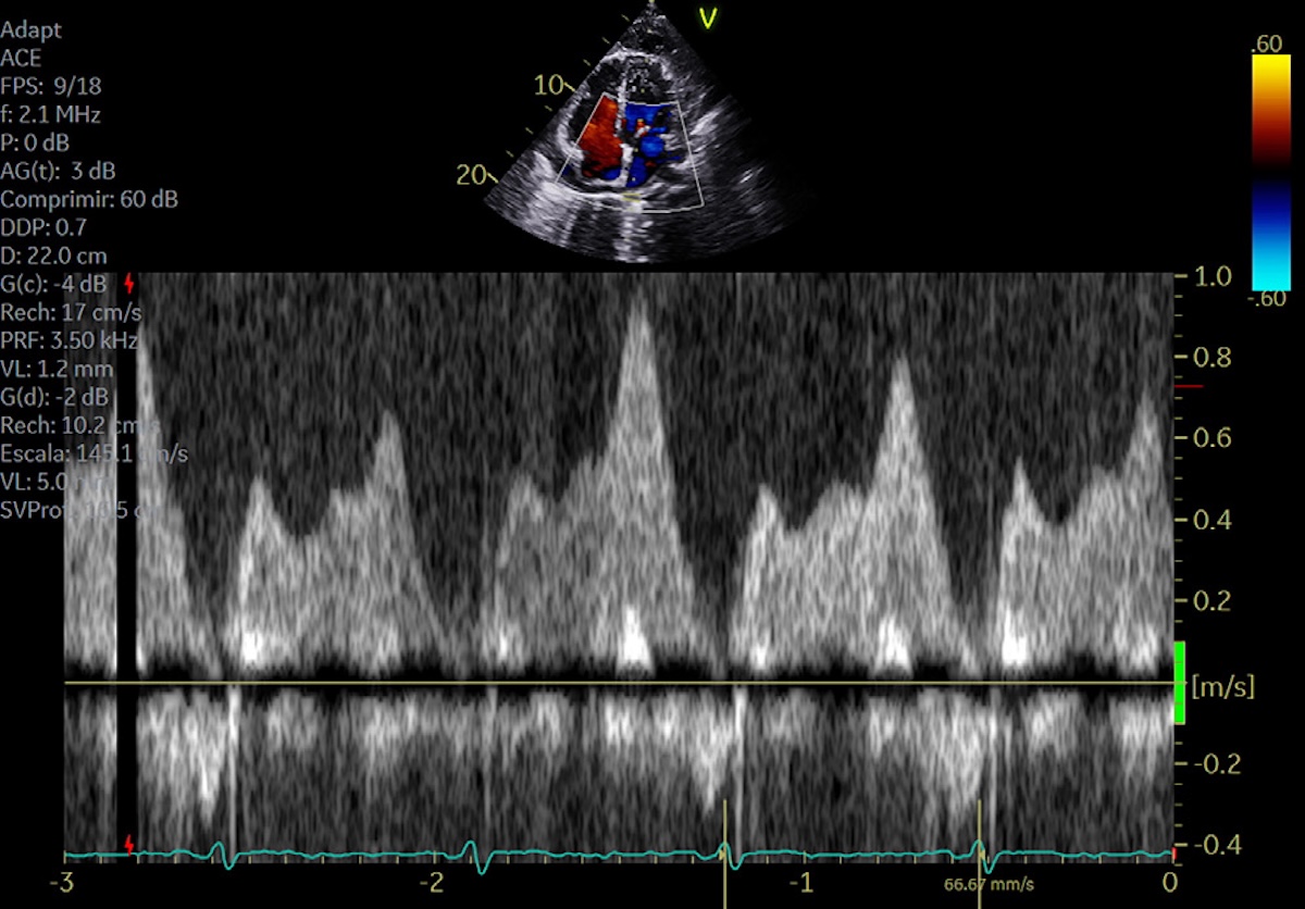 Figura 5. Flujo en la vena pulmonar inferior derecha.