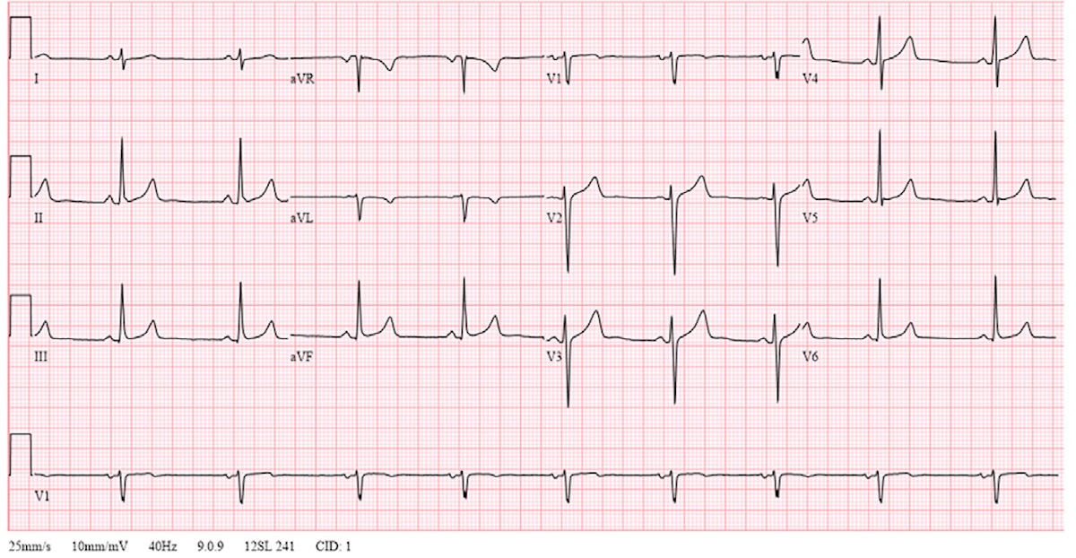 Figura 6. ECG de seguimiento. Resolución de las alteraciones de la repolarización.