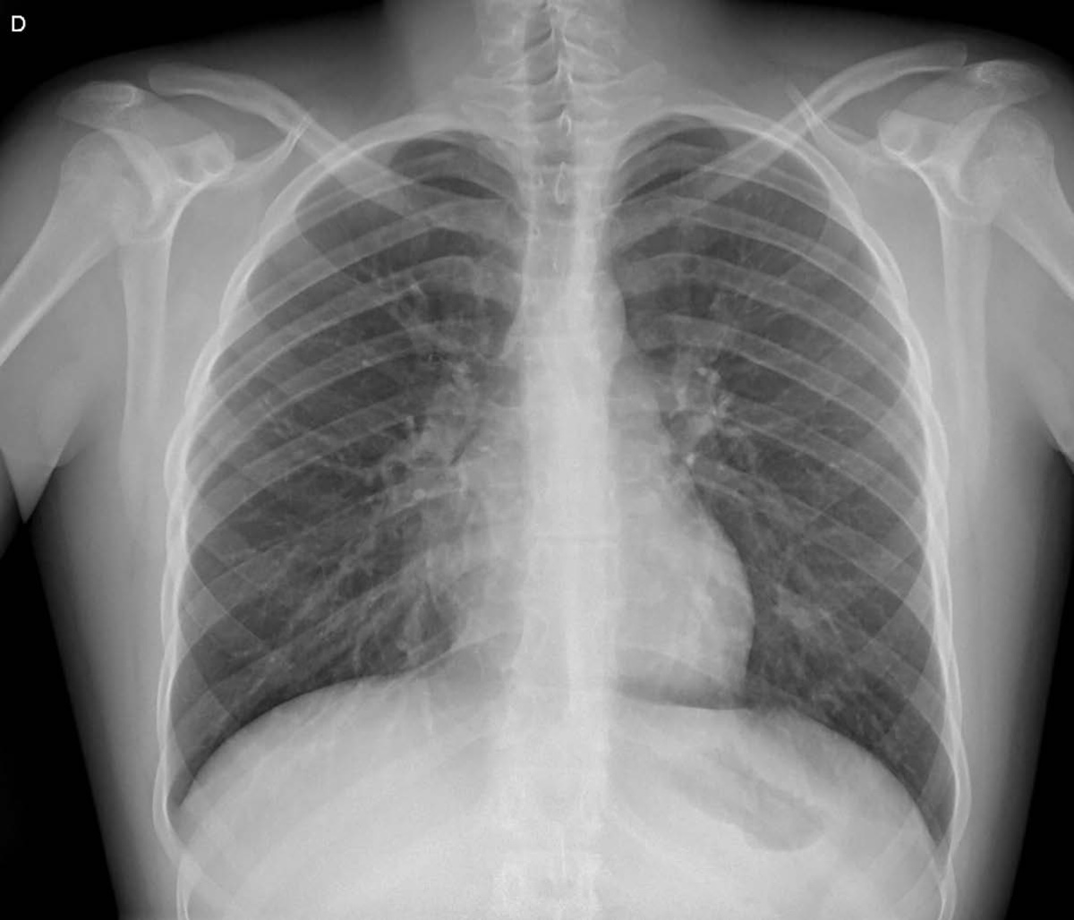 Figura 7. Radiografía de tórax de seguimiento. Normalización con resolución de la cardiomegalia.
