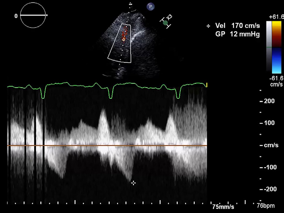 Figura 4. Gráfica presión/tiempo con doppler continuo obtenida a nivel medioventricular del VI, observando gradiente dinámico obstructivo no significativo en condiciones basales.