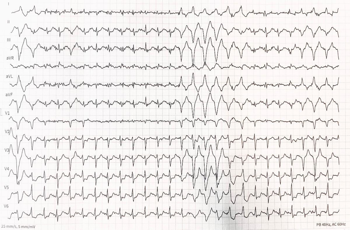 Figura 1. Electrocardiograma de 12 derivaciones durante el estudio de ergometría que demuestra un infradesnivel del ST de V4-V6 y salva de taquicardia ventricular.