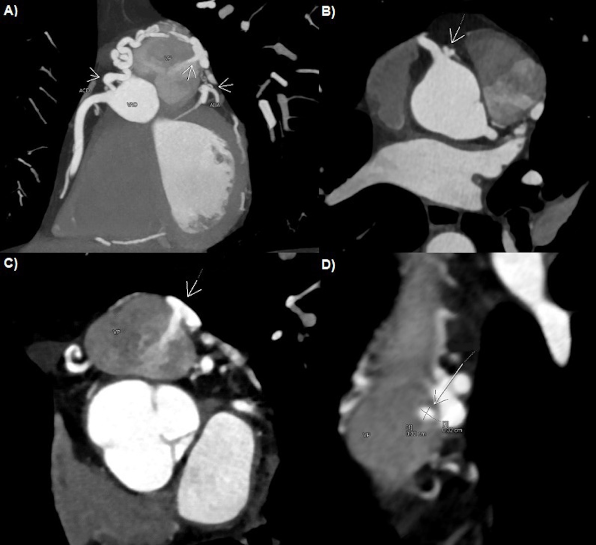 Figura 2. Angio-TC de arterias coronarias. A: anillo arterial de Vieussens desde la rama del cono, con trayecto prepulmonar tortuoso y dilatado con formación de ovillo vascular y conexión mediante una fina rama a la arteria descendente anterior proximal, visualizándose la fístula del ovillo a la arteria pulmonar. B: inicio del VAR a nivel de la rama del cono con origen independiente del seno de Valsalva derecho. C-D: fístula del VAR desde el ovillo vascular hacia el seno de Valsalva anterior de la arteria pulmonar, y su calibre (3,2 x 3,2 mm), demostrando franco cortocircuito izquierda-derecha.
