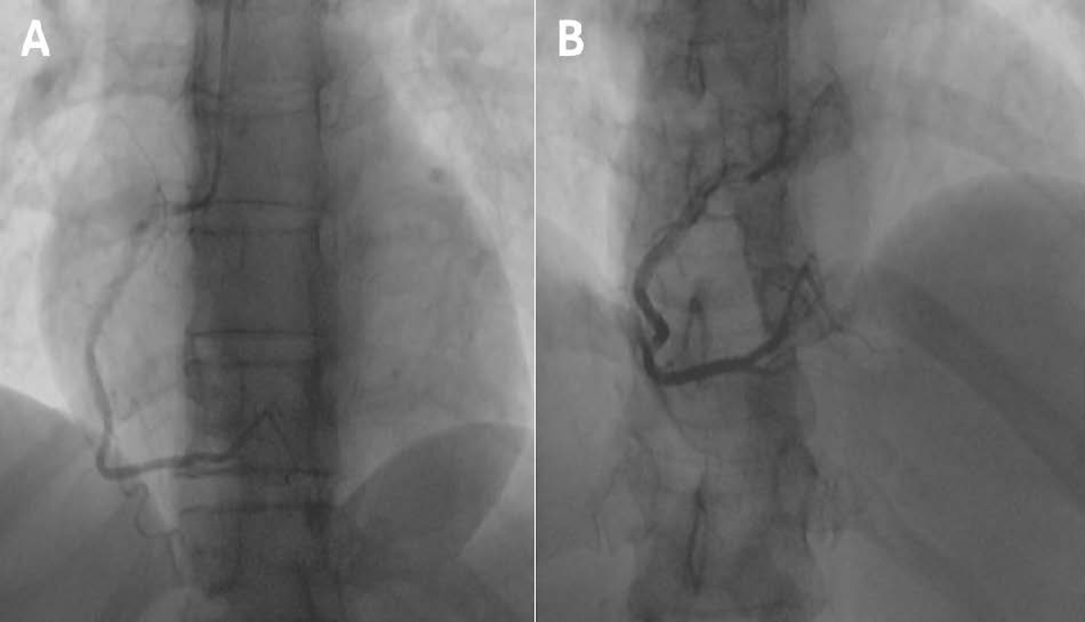 Figura 2. Coronariografía de la arteria coronaria derecha. A: proyección oblicua anterior derecha caudal. B: proyección oblicua anterior derecha craneal, dominante de buen calibre y desarrollo. Flujo TIMI III.
