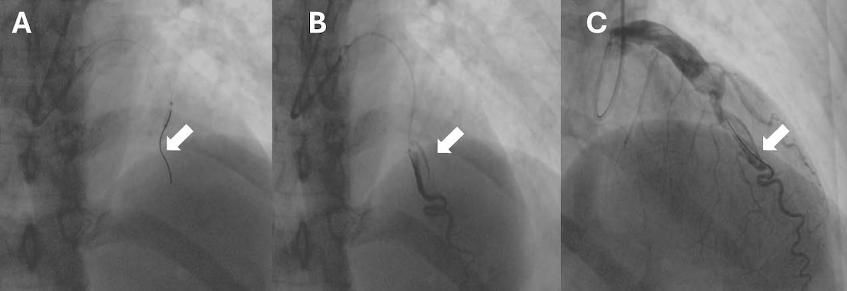 Figura 3. Angioplastia coronaria de la arteria descendente anterior. Mediante catéter guía xb 3.0, set de angioplastia (llave en Y, insuflador), se introduce cuerda coronaria 0,014’ × 190 cm, se logra trasponer lesión y se lleva cuerda hasta región distal de aneurisma, con dificultad se logra avanzar a tercio distal de descendente anterior. Se realiza dotter y predilatación desde el tercio distal al tercio medio con un balón convencional de 2,50 × 12 mm. Seguidamente, a través de un microcatéter doble lumen 3,2 Fr, se administra bolo intracoronario de tirofibán líquido parenteral de 0,25 mg/mL, con buen resultado angiográfico. Flujos finales TIMI 2 y Blush 2.