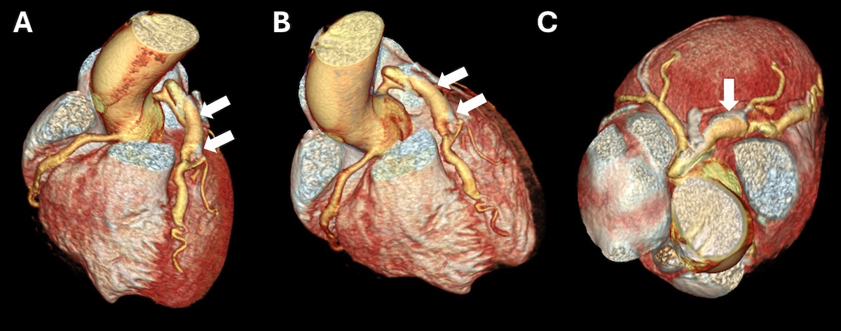 Figura 4. Angiografía cardíaca. Imágenes en construcción volumétrica, A y B en proyección oblicua anterior derecha, C en proyección superior. Arteria descendente anterior con origen y trayecto habitual, que alcanza el ápex del ventrículo izquierdo. Se observa un gran aneurisma fusiforme que compromete el ostium en el tercio proximal y medio, con importante carga trombótica, que abarca la mitad distal del aneurisma, y suboclusión, donde, a pesar de lo descrito, tiene adecuada columna de contraste distal. No se observan fístulas o comunicaciones vasculares al método.