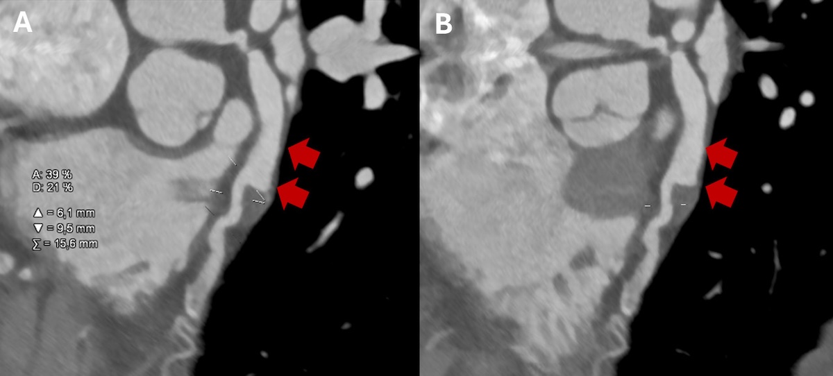 Figura 6. Angiotomografía cardíaca: imágenes en formato multiplanar curvo. A y B: arteria descendente anterior de trayecto habitual, en la que se observa un gran aneurisma fusiforme que compromete el ostium en el tercio proximal y medio, de 82 mm de longitud y con un diámetro mayor de 12 x 11 mm, con importante carga trombótica, que abarca la mitad distal del aneurisma, y suboclusión. Lechos de 2 mm.