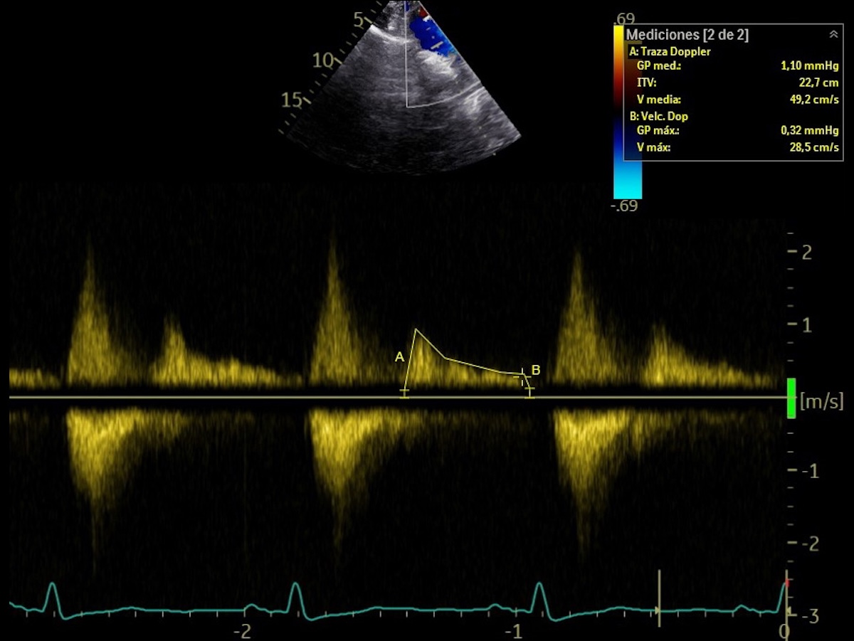 Figura 2. ETT sobre plano supraesternal con doppler pulsado a nivel de la aorta torácica descendente, en el que se aprecia flujo reverso holodiastólico con un IVT de 22,2 cm y una velocidad máxima telediastólica de 28,5 cm/s.