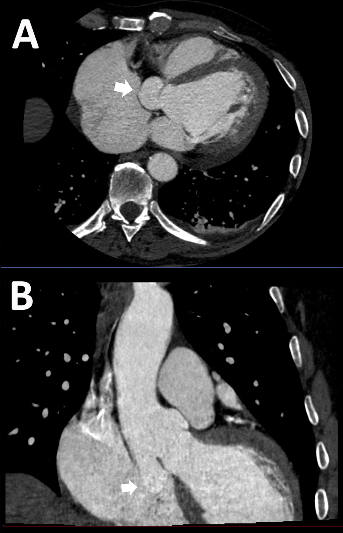 Figura 3. TC cardíaca en corte axial (A) y coronal (B). Ruptura del ASV (flecha), que crea una conexión anormal con la AD.