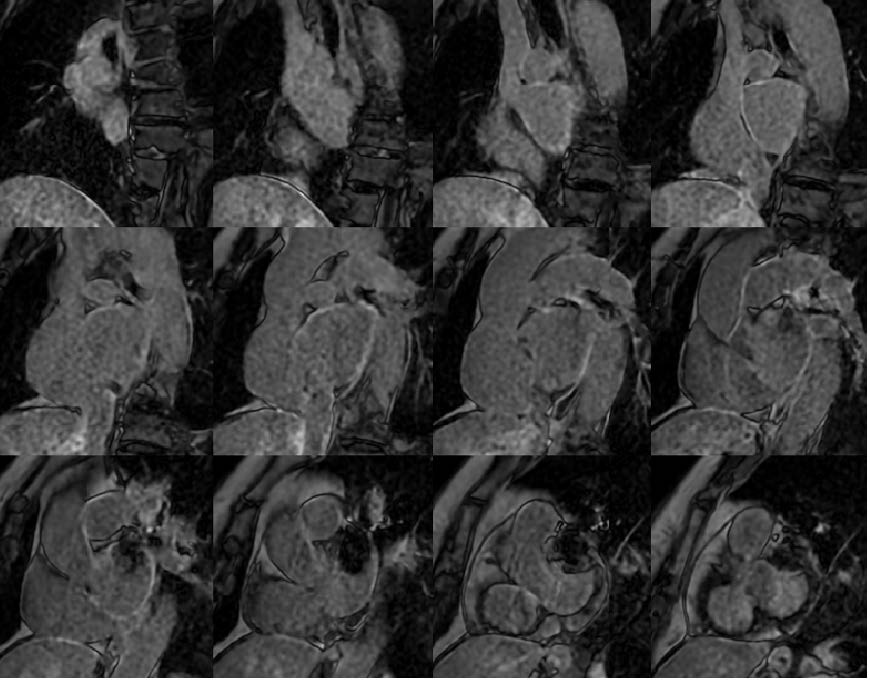 El síndrome cerebro corazón en la práctica clínica: un enfoque integral desde la imagen cardíaca para el diagnóstico diferencial y el manejo médico