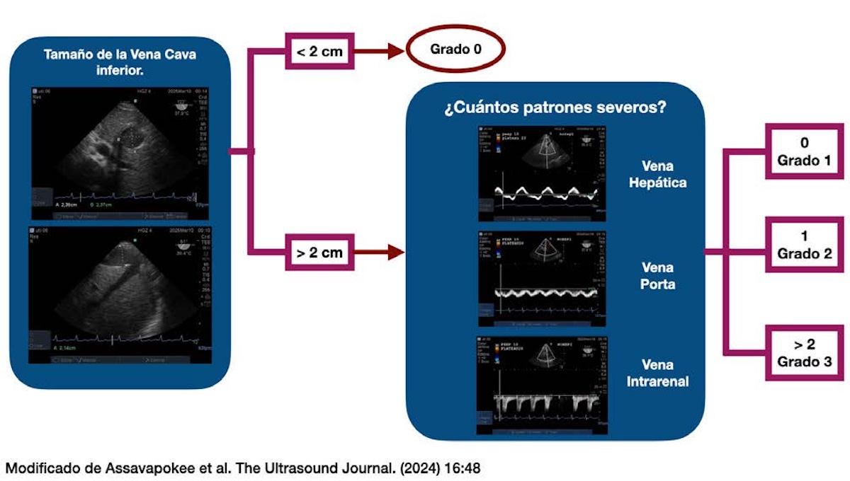 Ultrasonido de la congestión venosa sistémica (VExUS) mediante ecocardiografía transesofágica (T-VExUS) en pacientes críticos: generalidades y descripción de la técnica