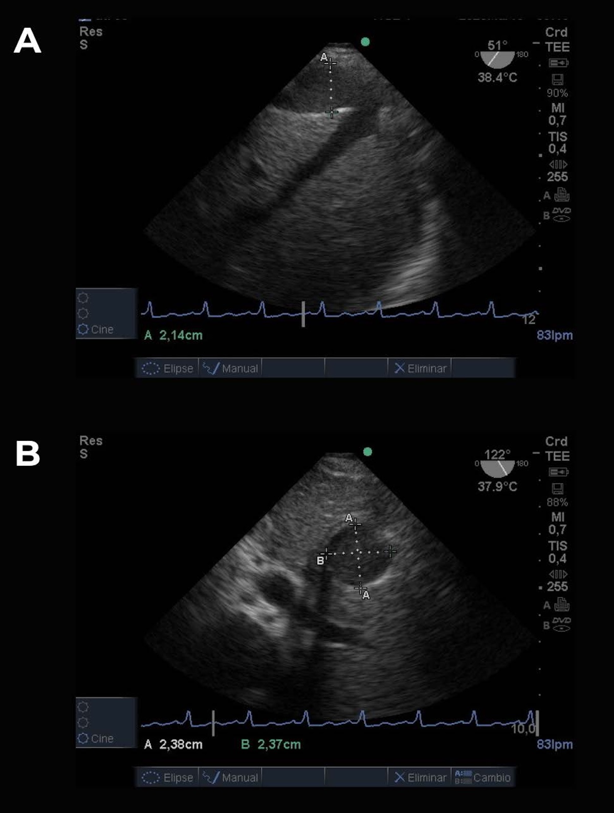Figura 2. A: VCI en modo B en su eje largo o longitudinal. B: en eje corto o transversal y método de medición de sus diámetros.