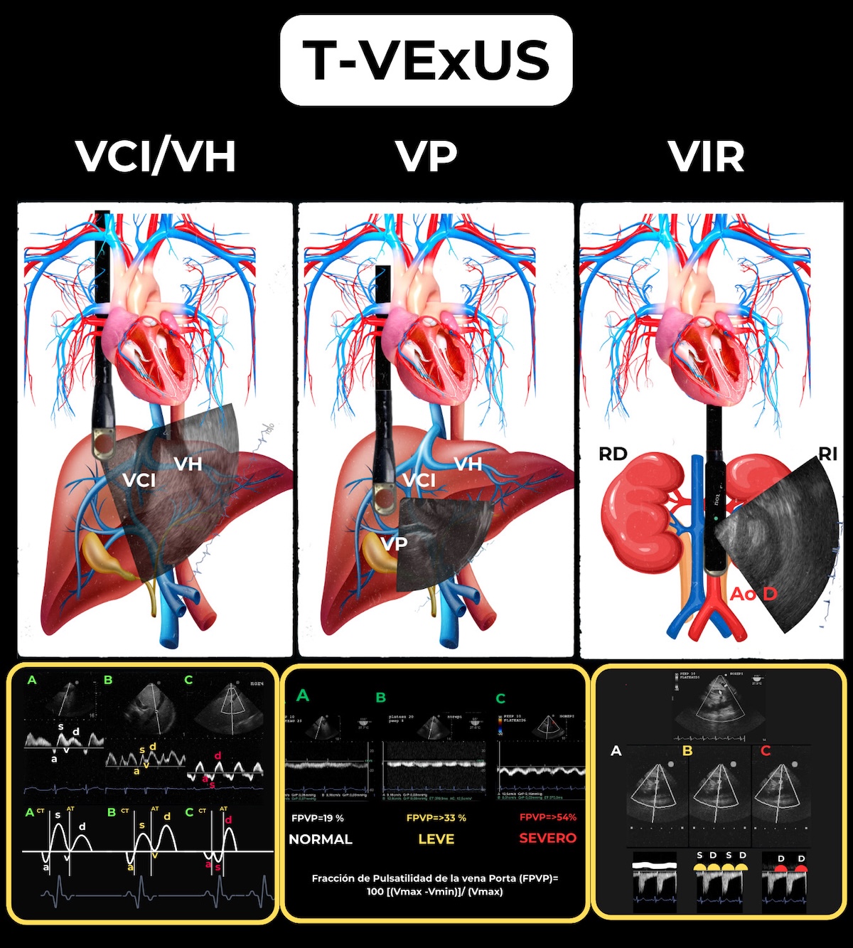 Figura 3. Representación esquemática de la VCI, VP y VIR obtenidas mediante ETE con su respectiva interpretación con doppler espectral.