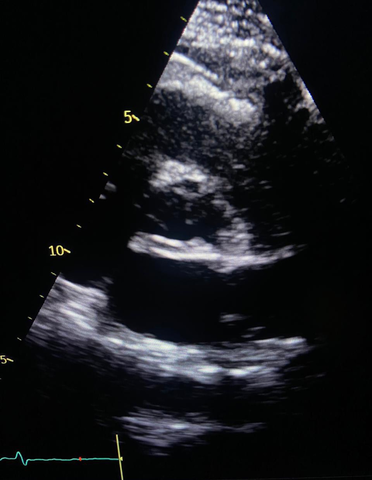 Origen anómalo de la arteria circunfleja diagnosticado por ecocardiografía transtorácica en paciente adulto, utilidad del signo de coronaria retroaórtica