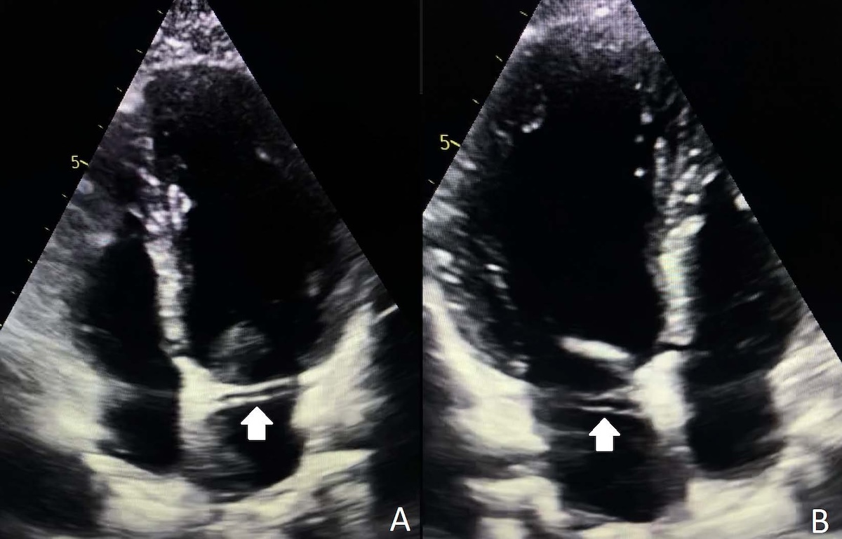 Figura 3. Proyecciones apicales de cuatro (A) y tres (B) cámaras en las cuales se observa el signo de RAC (flecha), correspondiente a un trayecto retroaórtico de la arteria circunfleja con origen anómalo en la arteria coronaria derecha.