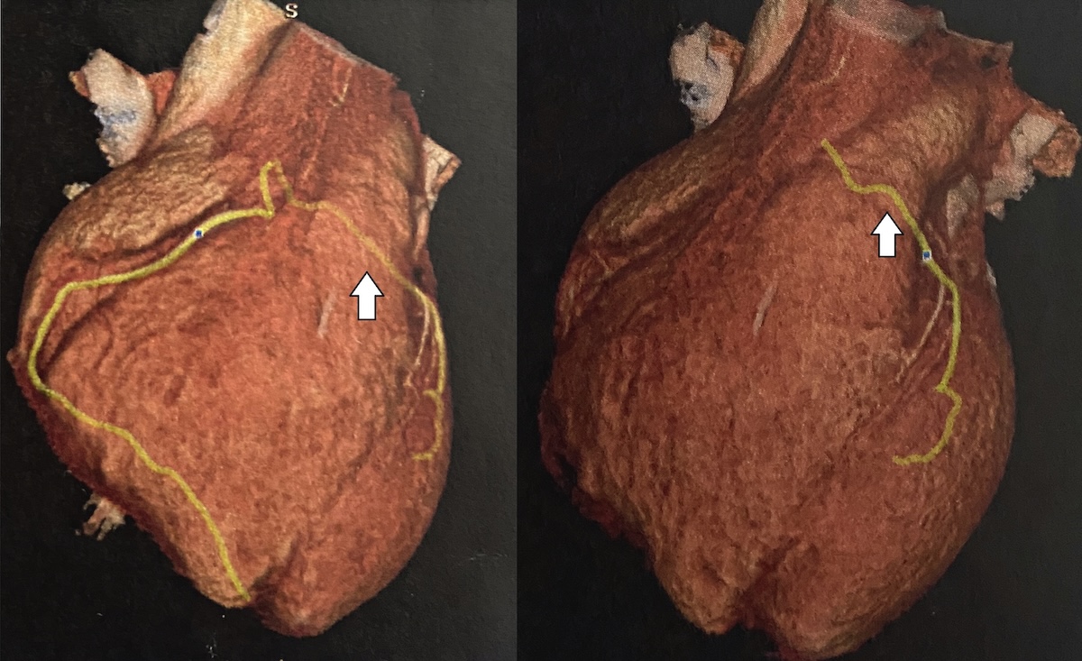Figura 4. Reconstrucción tridimensional de angiotomografía contrastada de arterias coronarias, en la cual se evidencia un trayecto retroaórtico de la arteria circunfleja (flecha), originada desde la coronaria derecha.