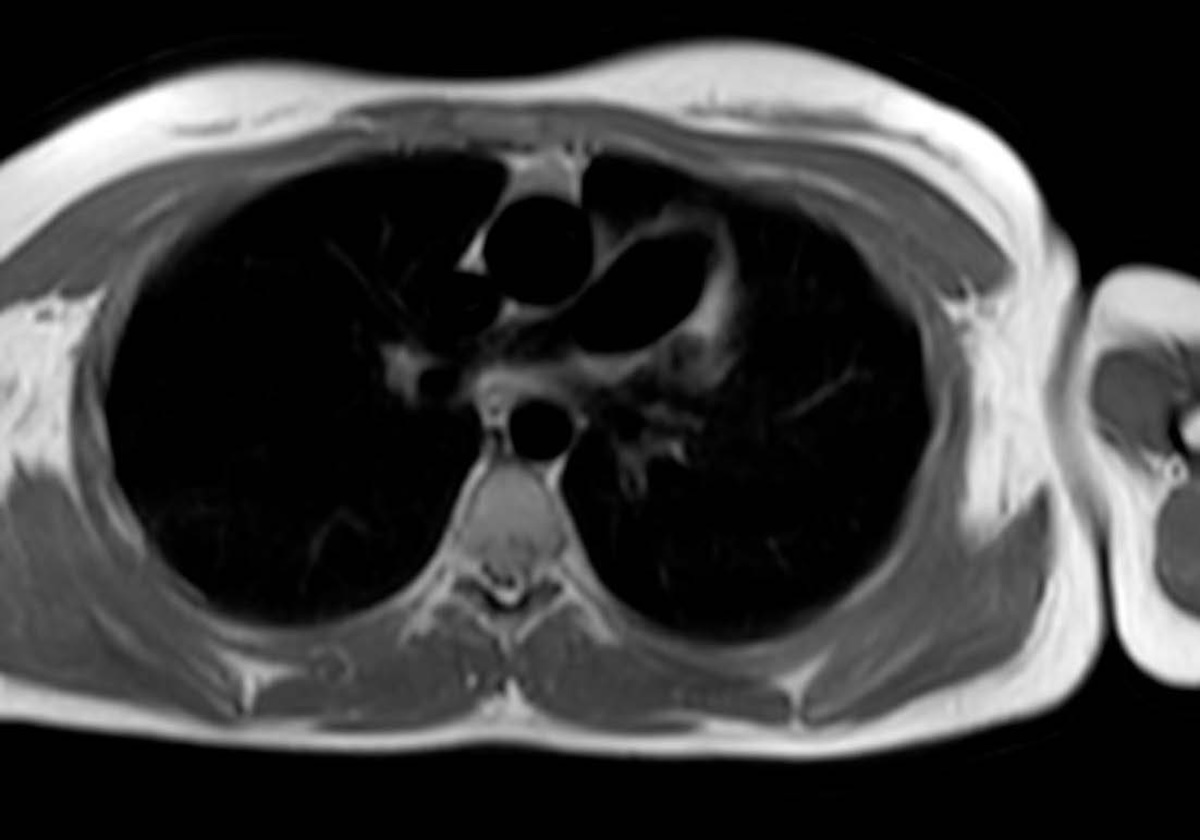 Figura 3. Resonancia magnética cardíaca. Secuencia T1 sangre negra, corte axial. A nivel del mediastino superior y anterior se observa la interposición de tejido pulmonar izquierdo entre el tronco pulmonar prominente y la aorta ascendente.