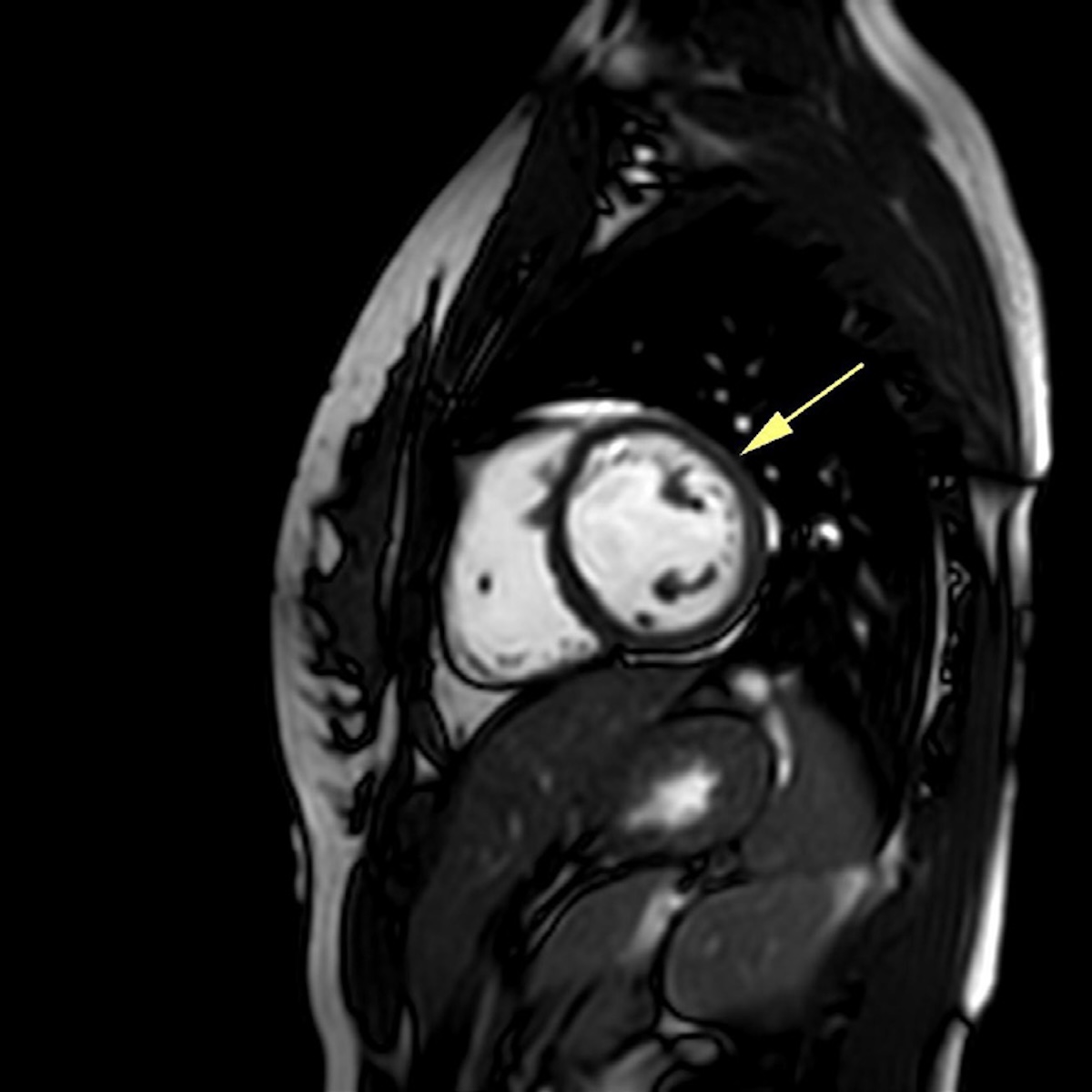 Figura 5. Resonancia magnética cardíaca. Secuencia cine SSFP de eje corto del ventrículo izquierdo (A) y dos cámaras (B) con ausencia de la delgada capa hipointensa entre el miocardio y la grasa mediastínica en región anterolateral y anterior medial y basal del ventrículo izquierdo.