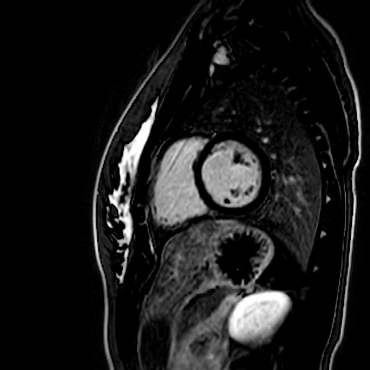 Figura 6. Resonancia magnética cardíaca. Secuencia PSIR. Ausencia de captación de realce a nivel del miocardio y pericardio. Nótese la ausencia completa de captación a nivel anterolateral medial por AP.