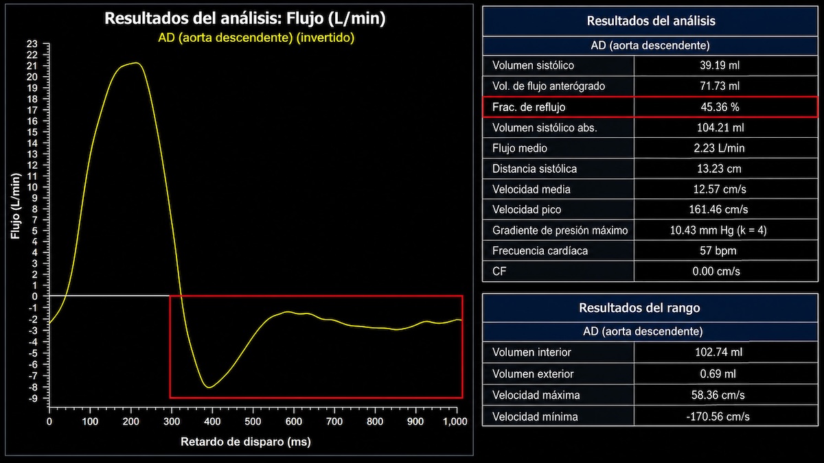 Figura 4. Cuantificación de la insuficiencia aórtica en el paciente del Caso 2 mediante contraste de fase en la aorta descendente (AD). La curva de flujo (representada invertida) muestra el pico anterógrado sistólico seguido de un marcado flujo retrógrado holodiastólico (recuadros), signo de regurgitación aórtica significativa. La cuantificación objetiva un volumen anterógrado de 71,7 mL, un volumen retrógrado de 32,5 mL y una fracción de reflujo del 45,4 %. Esta cuantificación se realizó en la aorta descendente, donde la fracción regurgitante es algo menor que en la aorta ascendente (51 %) por la derivación de flujo hacia los troncos supraaórticos.