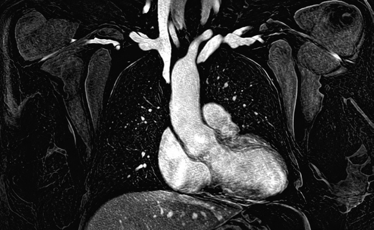 Figura 5. Angiorresonancia coronal de la aorta torácica que muestra la dilatación de la aorta ascendente (43,5 mm) y la anatomía posquirúrgica.