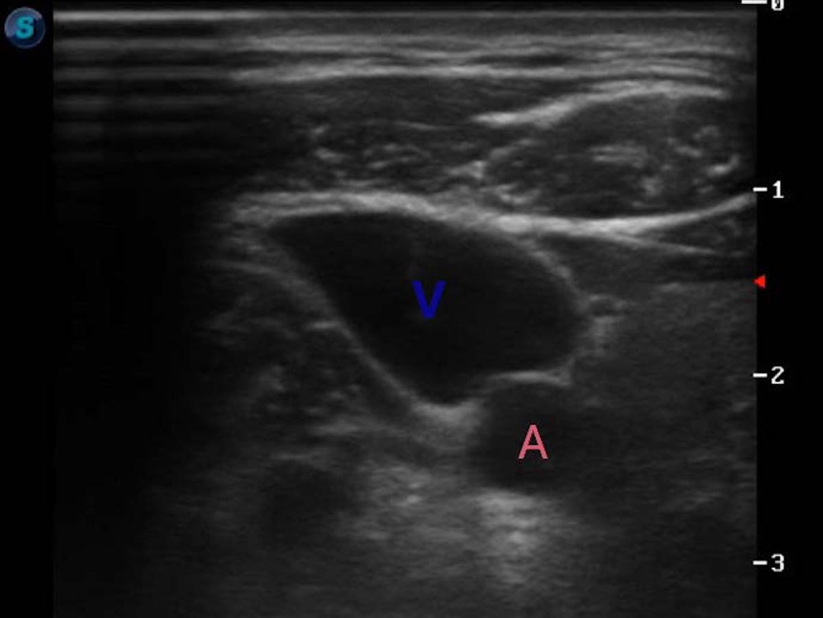 Figura 1. Ultrasonido de cuello, con transductor lineal, se observa la vena yugular distendida, (letra V en azul) y la Arteria carotida comun derecha (letra A en color rojo).