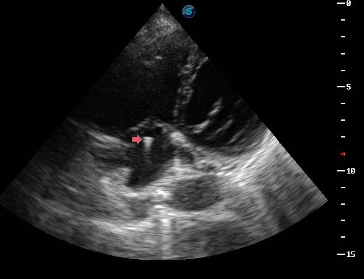 Figura 2. Visualización del electrodo del marcapasos temporal en aurícula derecha mediante ecocardiografía transtorácica. Imagen obtenida desde ventana apical de cuatro cámaras con enfoque a cavidades derechas. Se identifica el electrodo del marcapasos temporal ingresando a la aurícula derecha y avanzando hacia el ventrículo derecho. La visualización en tiempo real permite confirmar el trayecto adecuado del electrodo, optimizar su posicionamiento y prevenir malposiciones. Figura 2. Visualización del electrodo del marcapasos temporal en aurícula derecha mediante ecocardiografía transtorácica. Imagen obtenida desde ventana apical de cuatro cámaras con enfoque a cavidades derechas. Se identifica el electrodo del marcapasos temporal ingresando a la aurícula derecha y avanzando hacia el ventrículo derecho. La visualización en tiempo real permite confirmar el trayecto adecuado del electrodo, optimizar su posicionamiento y prevenir malposiciones.