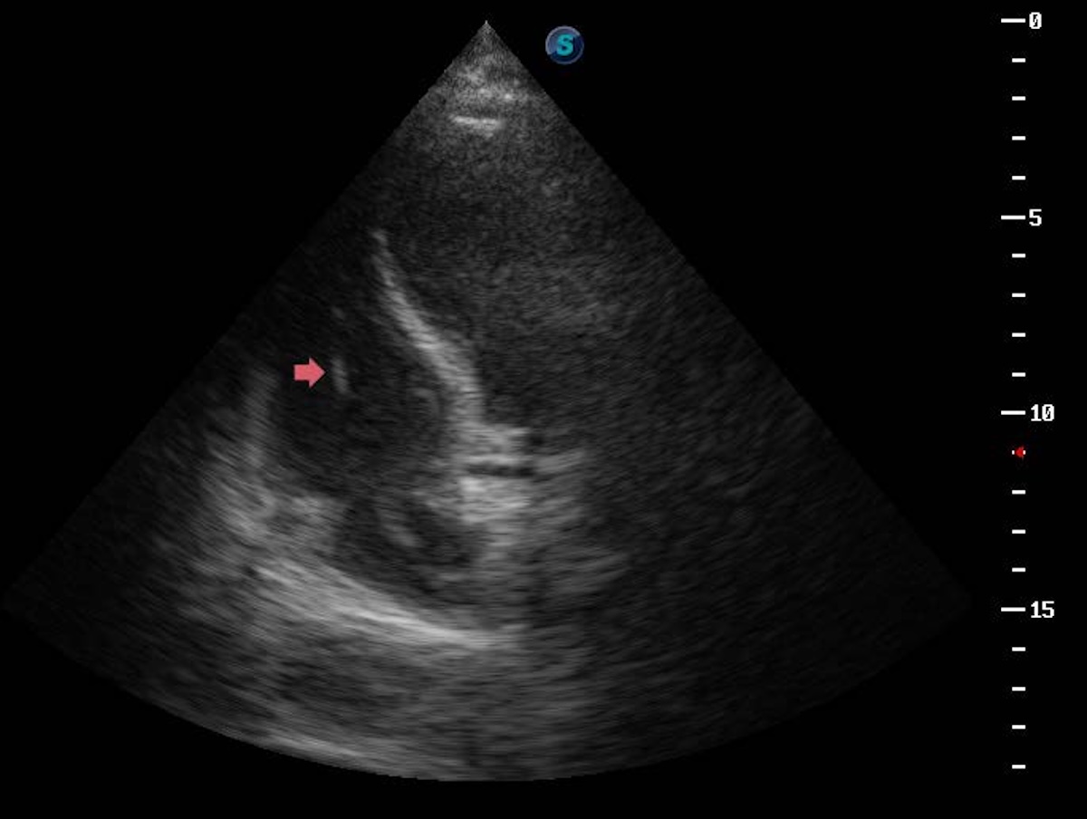 Figura 3. Visualización del electrodo del marcapasos cruzando la válvula tricúspide mediante ecocardiografía transtorácica. A través de la ventana apical de cuatro cámaras, con énfasis en el ventrículo derecho, se observa el electrodo del marcapasos (flecha roja) atravesando la válvula tricúspide y alojándose en el ventrículo derecho. La identificación directa del paso transvalvular es fundamental para asegurar un posicionamiento correcto y prevenir complicaciones como perforación del músculo papilar o daño de las cuerdas tendinosas. Figura 3. Visualización del electrodo del marcapasos cruzando la válvula tricúspide mediante ecocardiografía transtorácica. A través de la ventana apical de cuatro cámaras, con énfasis en el ventrículo derecho, se observa el electrodo del marcapasos (flecha roja) atravesando la válvula tricúspide y alojándose en el ventrículo derecho. La identificación directa del paso transvalvular es fundamental para asegurar un posicionamiento correcto y prevenir complicaciones como perforación del músculo papilar o daño de las cuerdas tendinosas.