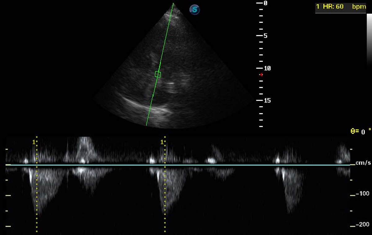 Figura 4. Verificación ecocardiográfica de la adecuada colocación y captura del marcapasos temporal mediante ecocardiografía transtorácica. La adecuada colocación se corroboró mediante ecocardiografía transtorácica en ventana apical de cinco cámaras. Se realizó Doppler pulsado a nivel del tracto de salida del ventrículo izquierdo para obtener la Integral Tiempovelocidad (VTI), confirmando la frecuencia cardíaca programada y la presencia de estimulación y captura ventricular efectiva por el marcapasos. Figura 4. Verificación ecocardiográfica de la adecuada colocación y captura del marcapasos temporal mediante ecocardiografía transtorácica. La adecuada colocación se corroboró mediante ecocardiografía transtorácica en ventana apical de cinco cámaras. Se realizó Doppler pulsado a nivel del tracto de salida del ventrículo izquierdo para obtener la Integral Tiempovelocidad (VTI), confirmando la frecuencia cardíaca programada y la presencia de estimulación y captura ventricular efectiva por el marcapasos.