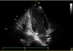 Área Apical - Corte 2 cámaras