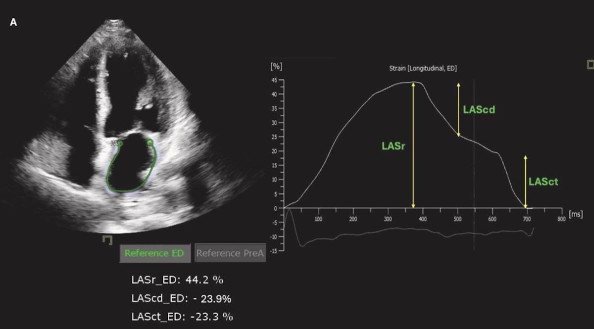 Función ventricular y auricular izquierda en pacientes con calcificación aislada del anillo mitral