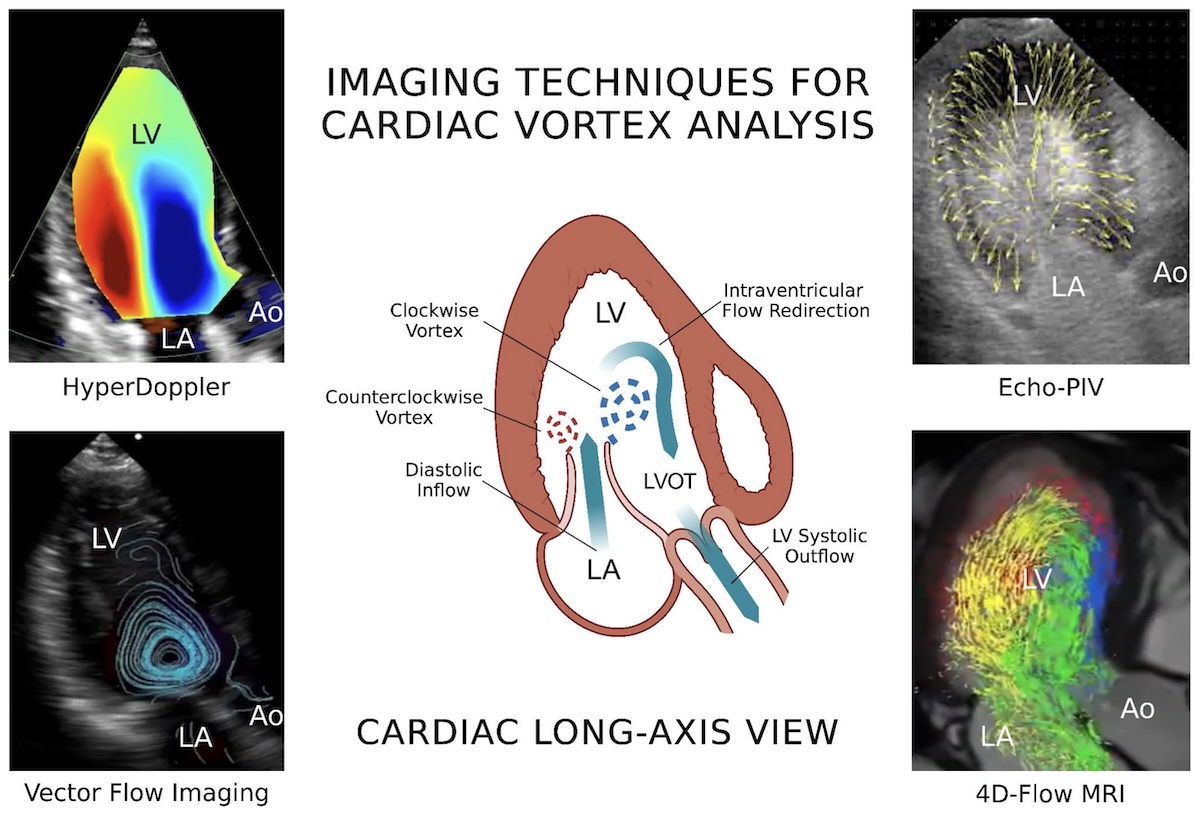Dinámica del flujo ventricular izquierdo con técnicas de imagen cardíaca en pacientes con insuficiencia cardíaca: estado del arte