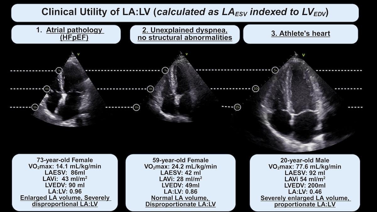Relación auriculoventricular izquierda (AI:VI): utilización del tamaño del ventrículo izquierdo como referencia para identificar el remodelado de la aurícula izquierda