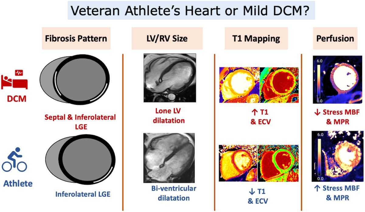 Resonancia magnética cardíaca para diferenciar el corazón de atleta veterano con dilatación de cavidad y miocardiopatía dilatada leve