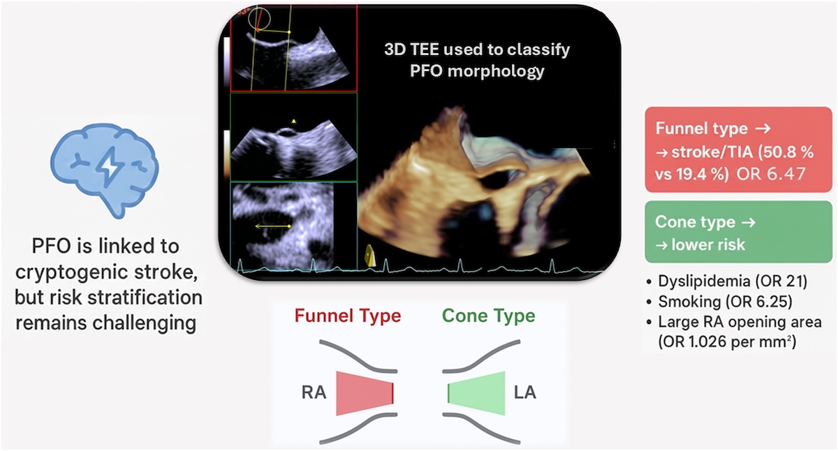 Morfología en embudo del foramen oval permeable en ecocardiografía tridimensional: una nueva característica anatómica de alto riesgo