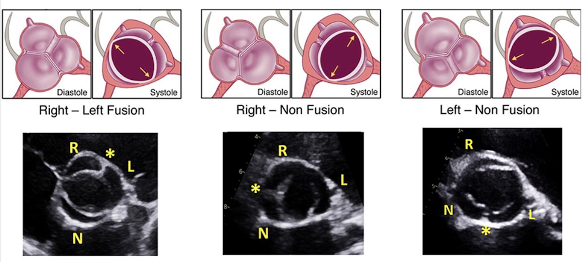 Estrategia de seguimiento ecocardiográfico en la aorta bicúspide detectada en la lactancia
