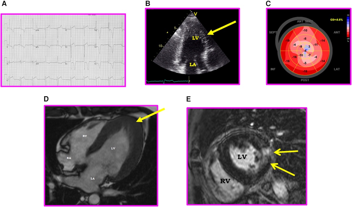 Fenotipo, genotipo y pronóstico de la miocardiopatías hipertróficas apical: cohorte multicéntrica francesa
