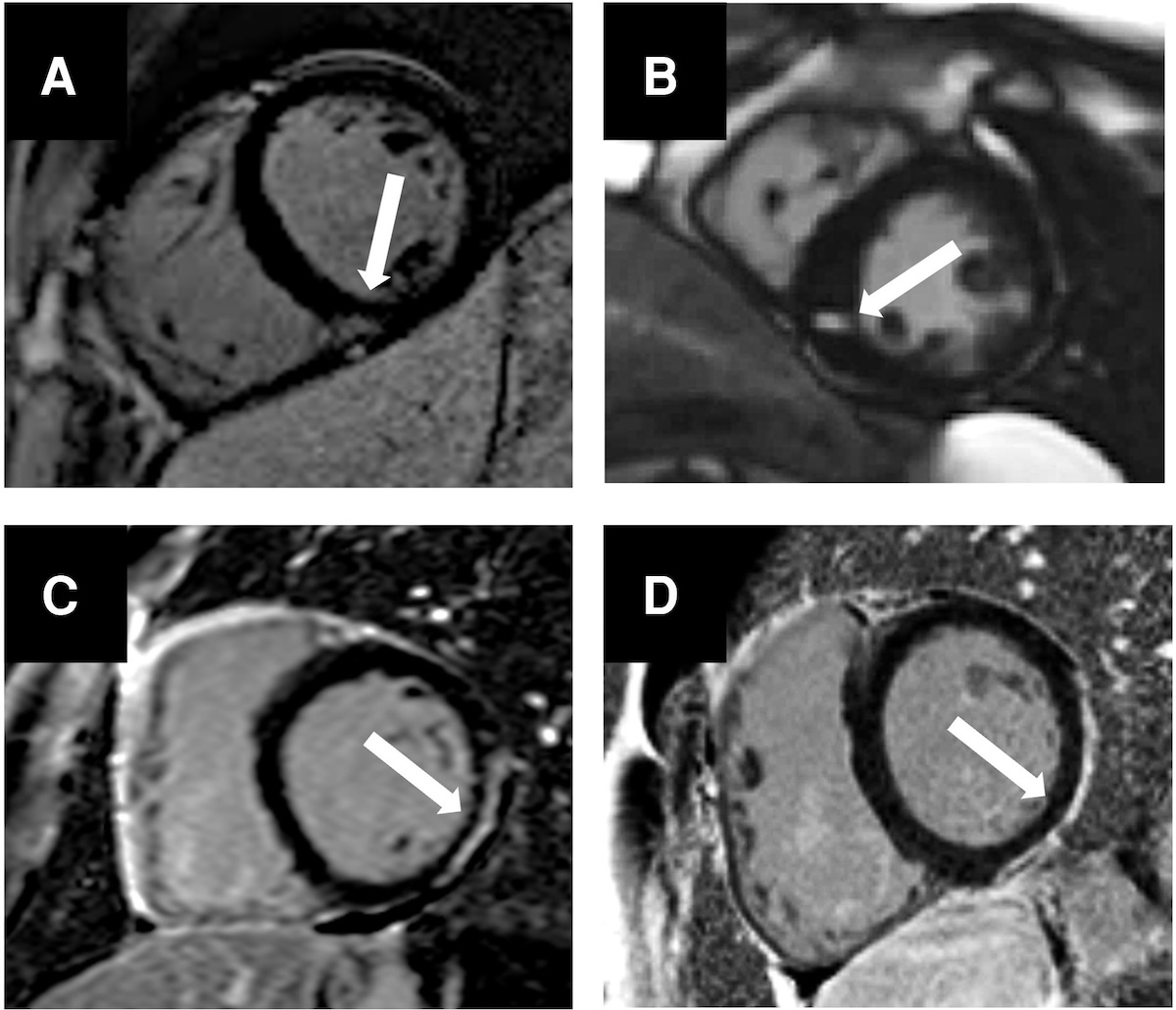 Indicaciones, protocolos e interpretación de las técnicas de imagen cardiovascular para la evaluación y el manejo de los deportistas. Parte 2: resonancia magnética cardiovascular, tomografía computarizada cardíaca e imagen nuclear