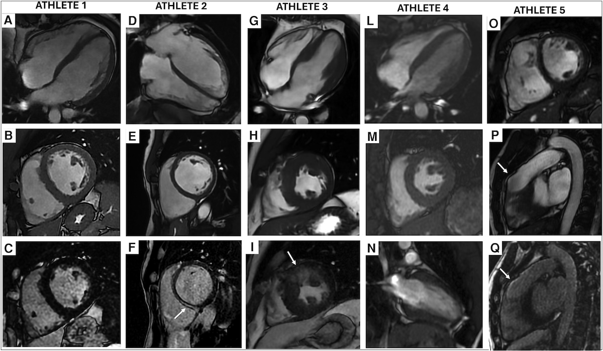 Indicaciones, protocolos e interpretación de las técnicas de imagen cardiovascular para la evaluación y el manejo de los deportistas. Parte 2: resonancia magnética cardiovascular, tomografía computarizada cardíaca e imagen nuclear Indicaciones, protocolos e interpretación de las técnicas de imagen cardiovascular para la evaluación y el manejo de los deportistas. Parte 2: resonancia magnética cardiovascular, tomografía computarizada cardíaca e imagen nuclear