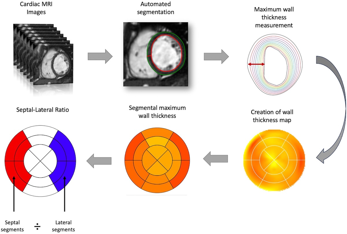 Prevalencia y determinantes de la hipertrofia septal asimétrica en enfermedades asociadas con hipertrofia ventricular izquierda Prevalencia y determinantes de la hipertrofia septal asimétrica en enfermedades asociadas con hipertrofia ventricular izquierda