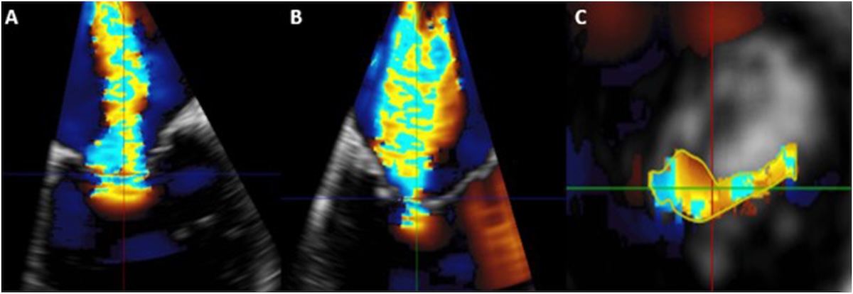 Área tridimensional de la vena contracta en la insuficiencia mitral secundaria ventricular: asociación con el pronóstico tras intervención mitral