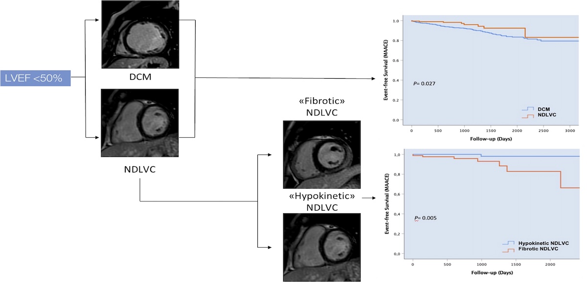 Uso  de la CRMN  para la valoración  de terapia profiláctica con desfibrilador automático implantable (DAI) en la miocardiopatía no dilatada: un sub-estudio del registro DERIVATE