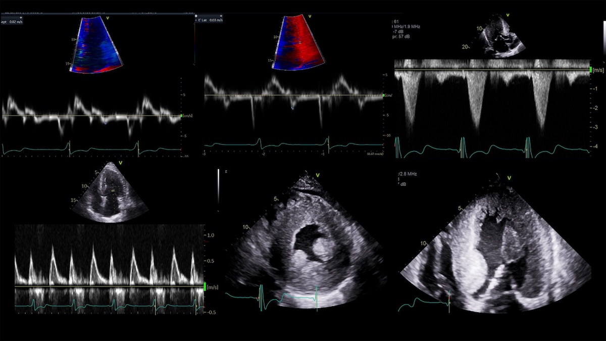 El papel de la imagen cardiovascular multimodal en la evaluación de la enfermedad de Anderson–Fabry: desde el diagnóstico precoz hasta la monitorización del tratamiento: documento de consenso